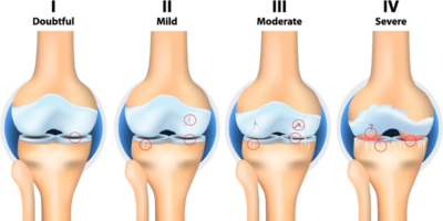 Recent advances in physiotherapy for OA knee with current evidence based studies